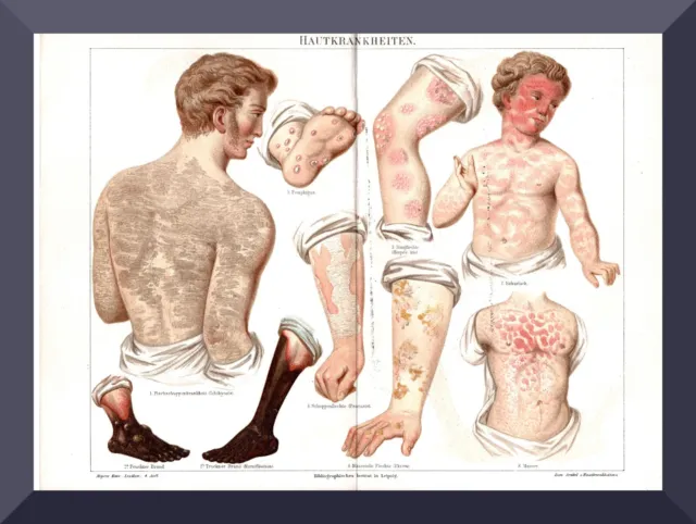 +HAUTKRANKHEITEN+ wunderschöne Chromolitho 1888 +Dermatologie,Hautkrebs,Brand+