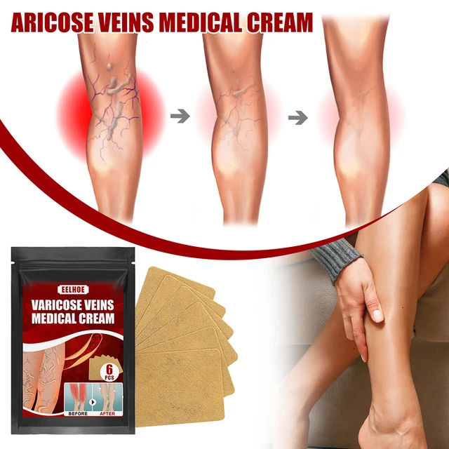 Body Vasculitis Phlebitis Spider Pain Relief Plaster Unisex Health Care Patches 3