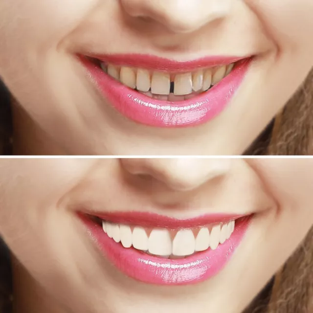 Imako Cosmetic Teeth Veneer Cover. Instant Smile. Hollywood Bling. Simon Cowel
