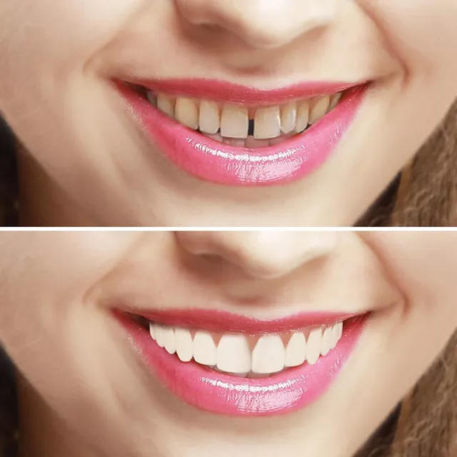 Imako System Cosmetic Teeth Cover, Instant Smile. Natural or Bleached.