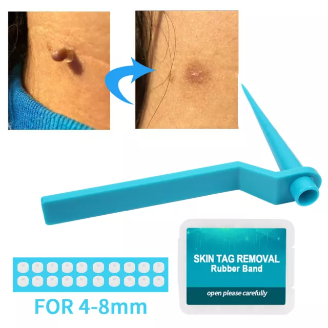 Skin Tag Remover Device for Large Mole Wart Removal with Removal Band Cleansing