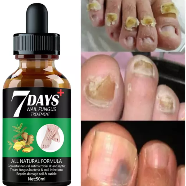 Sérum de traitement des champignons des ongles, soin des mains et des pieds, gel