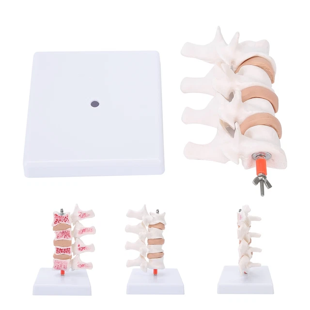 OSTEOPOROSIS MODEL HUMAN Anatomical Spine Model For Teaching ...