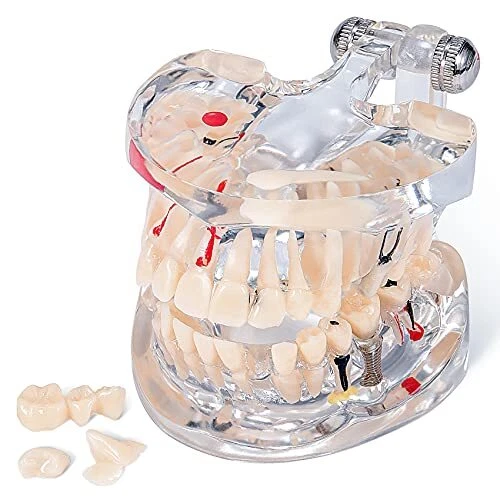 Transparent Tooth Model Dental Disease Implant Teeth Model Removable, Dentist