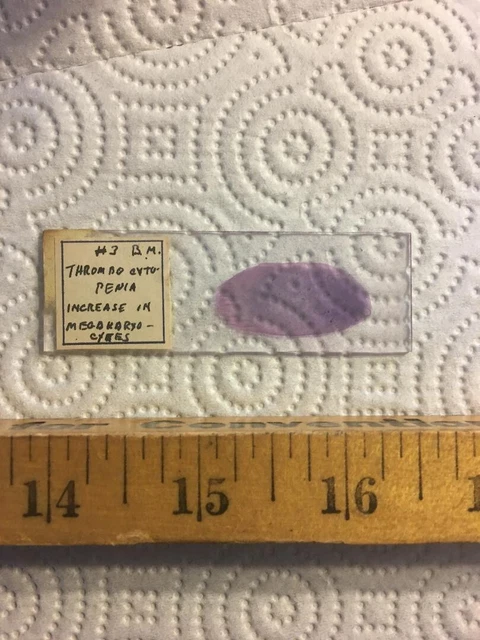 Antique Vintage Microscope Slide  "Thrombocytopenia"