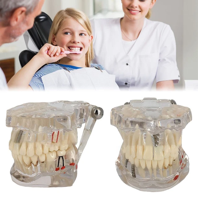 DENTISIT MEDICINE BRIDGE Model Dental Model Implanted Teeth Tooth Model ...