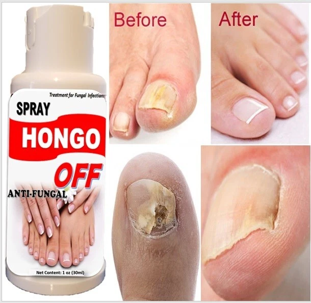 ANTI FUNGAL TREATMENT Extra Strength Toenail Fungus Fungi Xs Nail