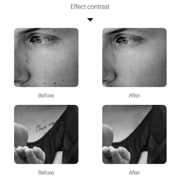 Handheld-Picosecond-Stift Blaulicht Tattoo Sommersprossen Dunkelfleckenentfe OBD