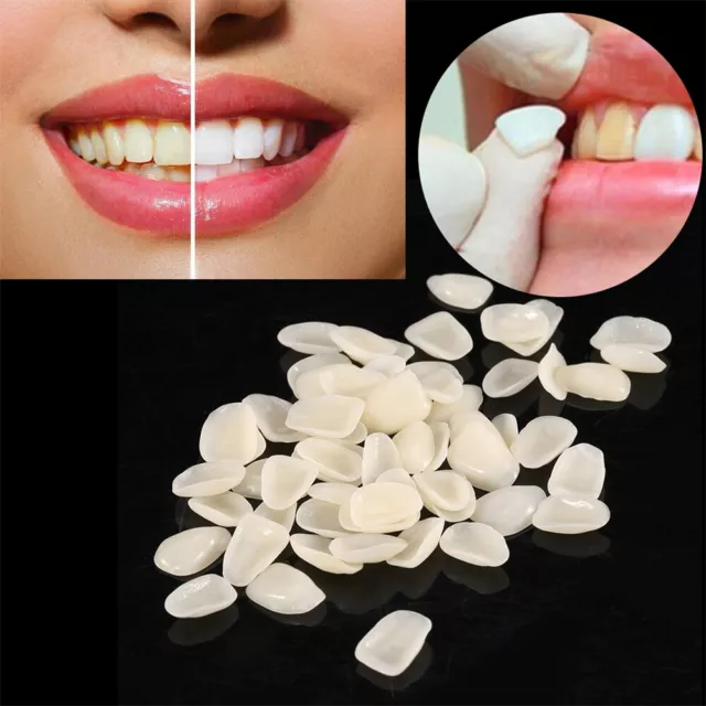 70Pcs/Pack Dental Temporary Crown Veneers for Anterior Front Teeth Whitening USA