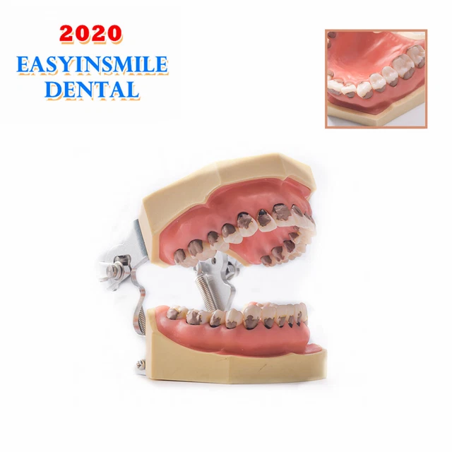 Dental Calculus Teach Study Model Periodontal Periodontitis Soft Gingivitis 1Pcs