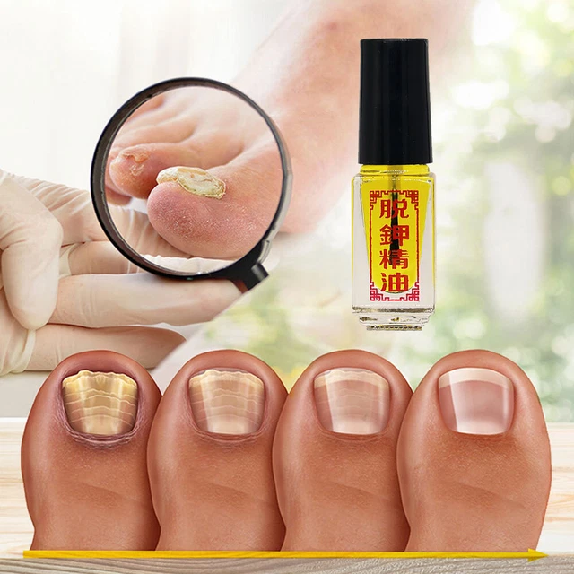 NAILS TREATMENT REMOVAL onychomycosis Paronychia AntiFungal Nail