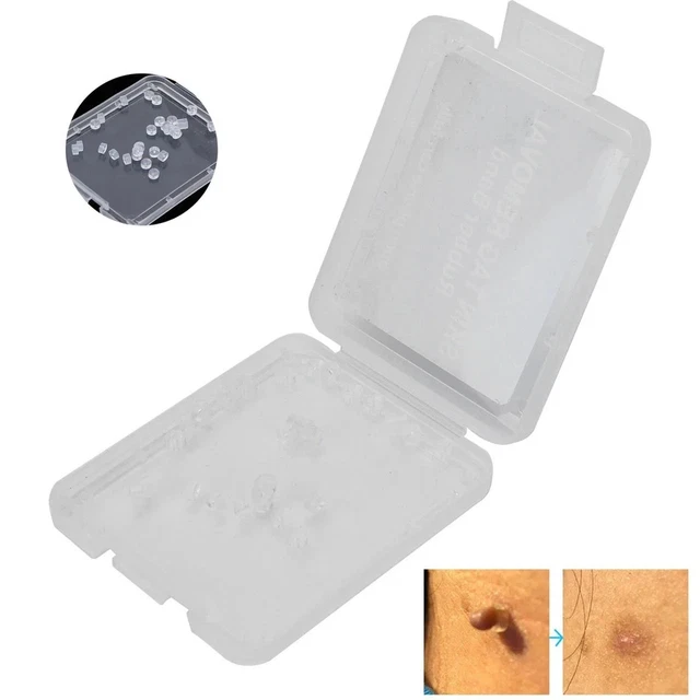 Compound Skin Tag SKIN TAG REMOVAL Rubber Bands Safe Band Non Toxic Mole Wart Skin Care ...