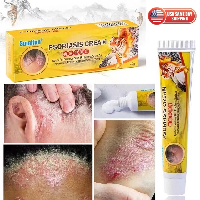 HEALTH CARE PSORIASIS Cream Eczema Ointment Scalp Psoriasis Hand Tinea