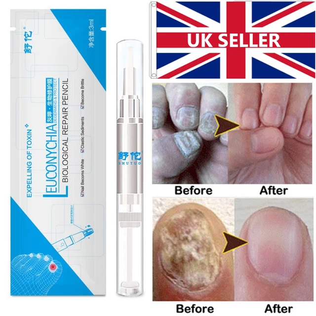 NAIL FUNGUS TREATMENT Pen Anti Fungal Nail Infection Treatment 3ml