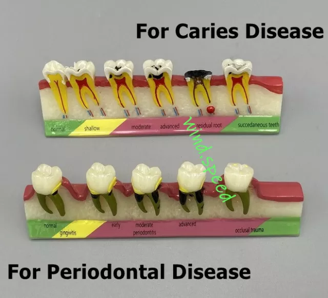 Dental Teeth Dentoform Models Caries Periodontal Disease Study Teaching Model