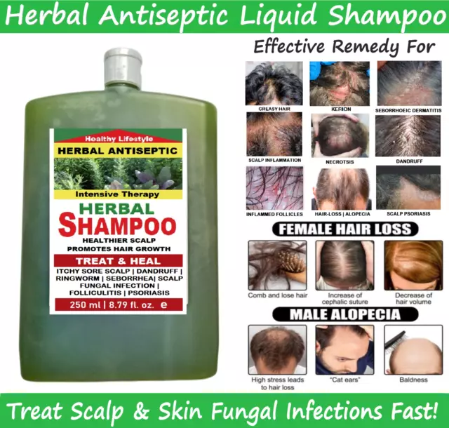 Herbal Shampoo Treatment for Dandruff, Itchy Scalp, Seborrhea, Hair-Loss  250 ML