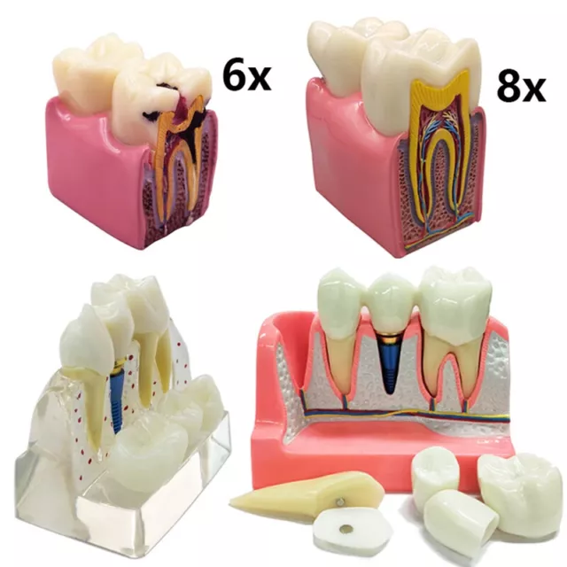 Dental Implant Analysis Removable Crown Bridge Caries Tooth Model Disease Study