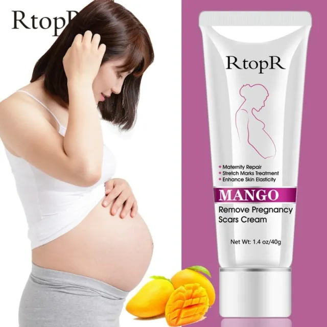 Rtopr Mango Remove Pregnancy Scars Remove Acne Cream MarksStretch Treatment 40g