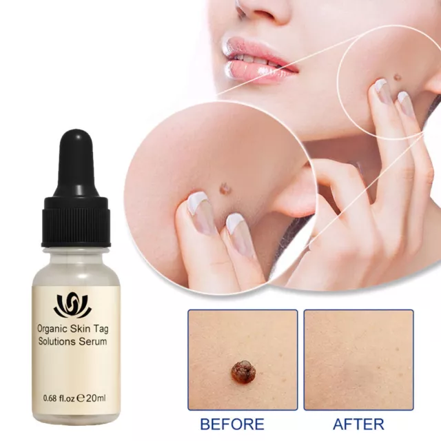 12 Hour Wart Remover Pen Skin Tag Mole Remover Eliminate Foot Corn Wart  Painless
