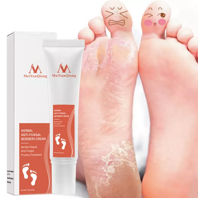 Foot Anti-Inflammatory Cream Anti-Fungal Infection Removal Feet Callus Dead Skin