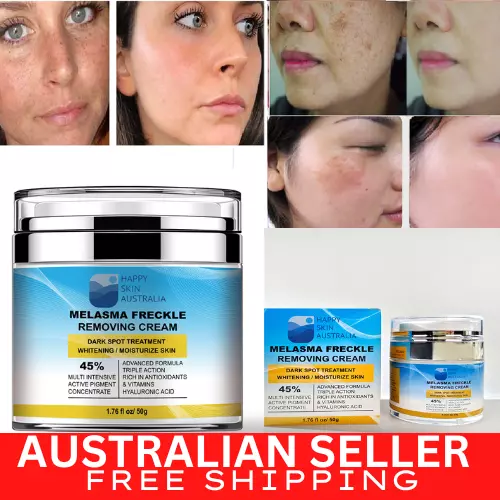 Melasma Freckle Removing Cream, Whitening Skin, Spots Treatment Moisturized Skin