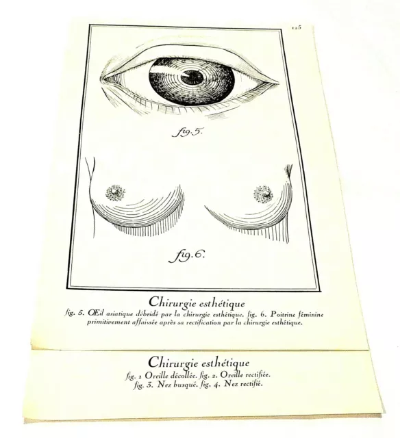 Gravures anciennes Chirurgie esthétique aux choix issues du livre Diderot 1971