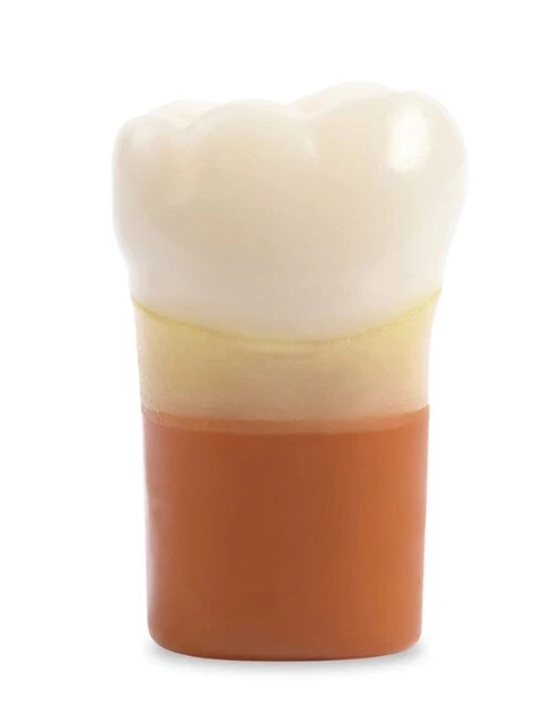 Acadental ADEX DTX Carious Tooth #30 D