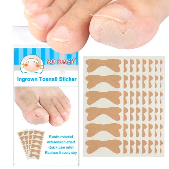 INGROWN TOENAIL CORRECT Sticker Paronychia Recover Nail Care Toe Patch