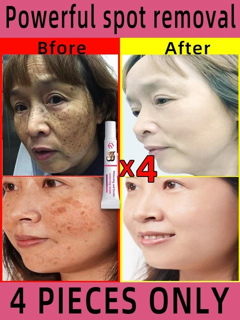 Crema para eliminar pecas SHIBALISTORE eliminar manchas faciales eliminar manchas oscuras de la piel