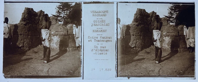 ELEPHANTIASIS GUINEE 1890 PLAQUE VERASCOPE RICHARD 45x107 VUE STEREOSCOPIQUE