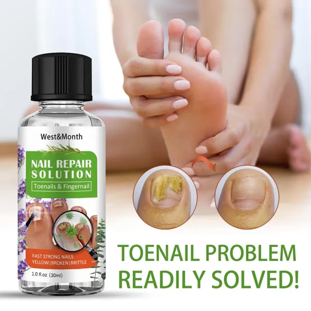 Solución de hongos en las uñas de los pies para tratamiento de uñas y uñas, 30 ml de aceite de árbol de té