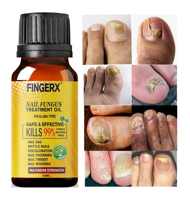 Fongyl ANTI FUNGAL TREATMENT Extra Strength Toenail Fungus Fungi Nails Oil UK ...