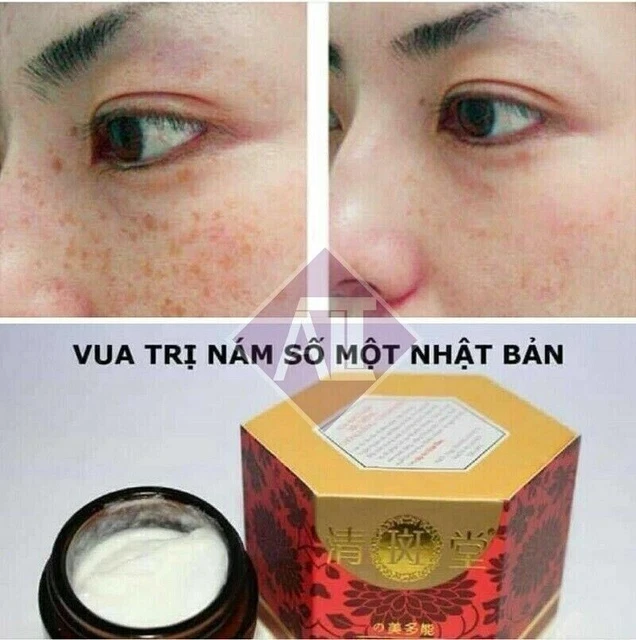 2 Vua Tri Nam - Crema de melasma, pecas, piel blanca, protector solar