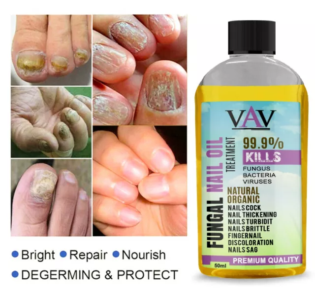 Anti Fungal Treatment Fungus Effective Finger Toe Nail Repair Liquid Solution UK