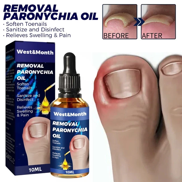 Paronychia Relief Oil Ingrown Toenails Care Oil Nail Serum Nail Recover Oils