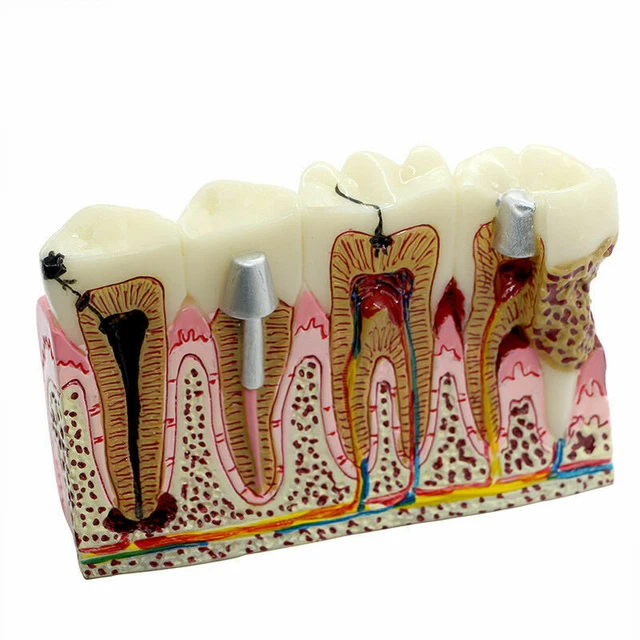 DENTAL CARIES ANATOMY tooth Model Caries anatomy model Teaching&study ...