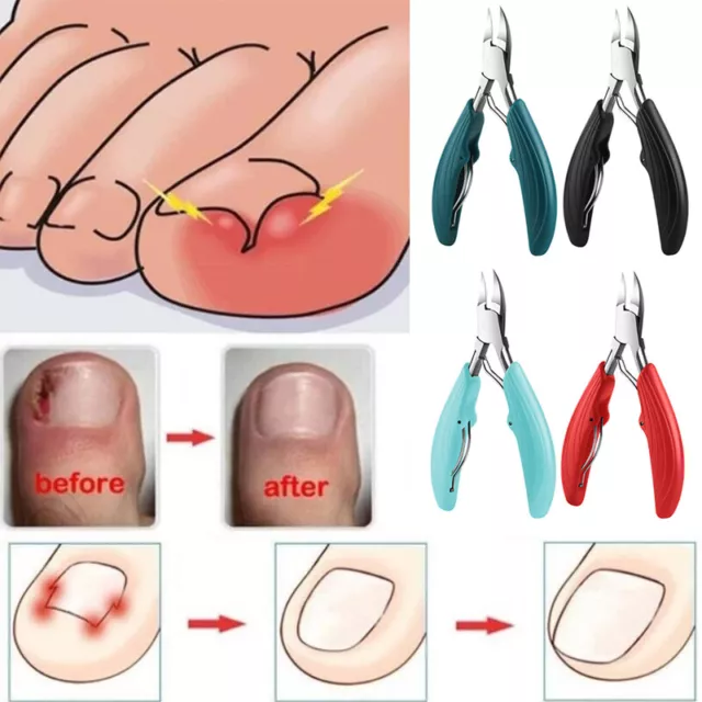 Coupe-Ongles Paronychia Outil Pince À Ongles Incarnés Coupe-Ongles Pédicure R