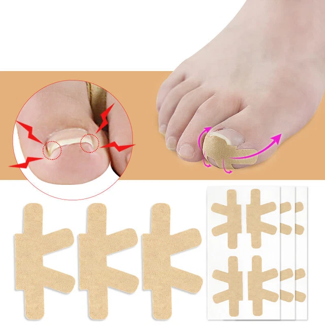 INGROWN TOENAIL CORRECTOR Sticker Paronychia Treatment Foot Toe Nail ...