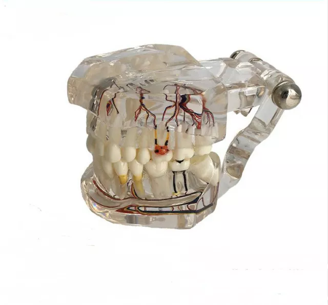 Dental teeth model implant with nerve Transparent Repair model Teaching model