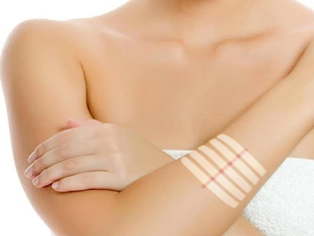 Cerotto Strisce Di Sutura - Strip in TNT Sterili Traspiranti E Ipoallergeniche -