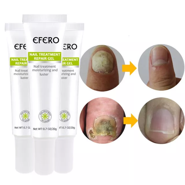 1Pcs Anti Fungal Nail Treatment Cream Onychomycosis Nail Infection Feet Care