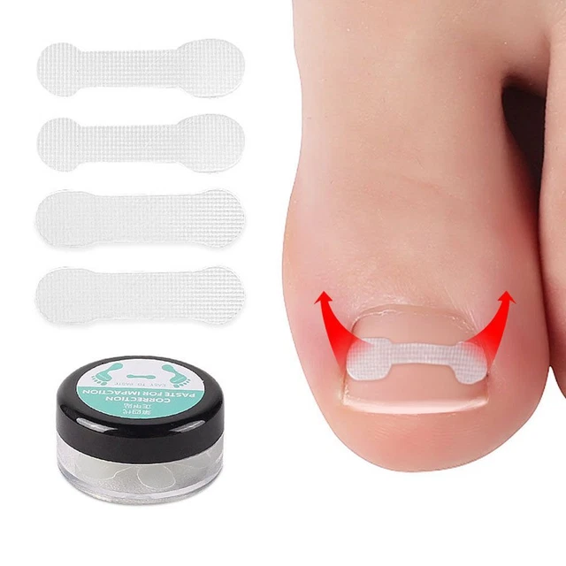 de correction Outil de correction des ongles incarnés Autocollants pour ongles