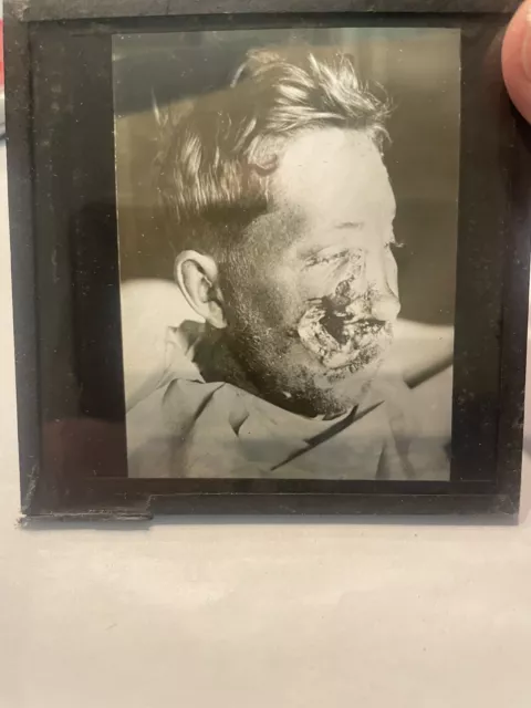 Antique Medical GLASS SLIDE Face Injury prior SURGERY Massive Damage   #15 c1916