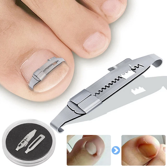 PARONYCHIA CORRECTOR CLIP Toenails Cure Relief Pain Recover Strips
