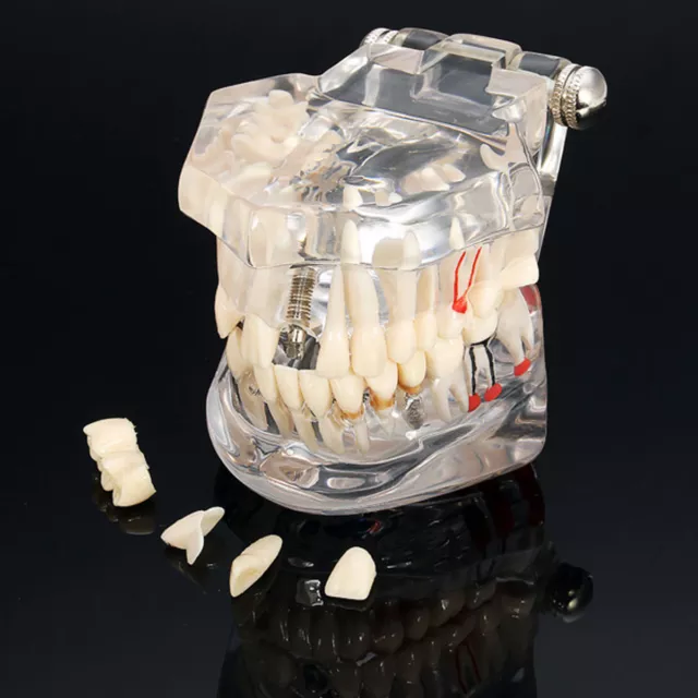 Dental Implant Disease Study Teaching Teeth Model With Restoration&Bridge Tooth