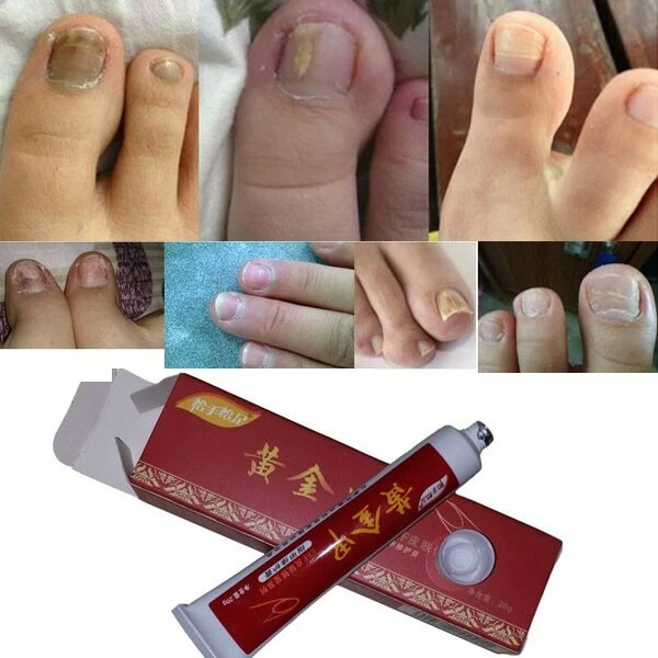 BEST NAIL FUNGUS Treatment /Onychomycosis Paronychia /Anti Fungal Nail