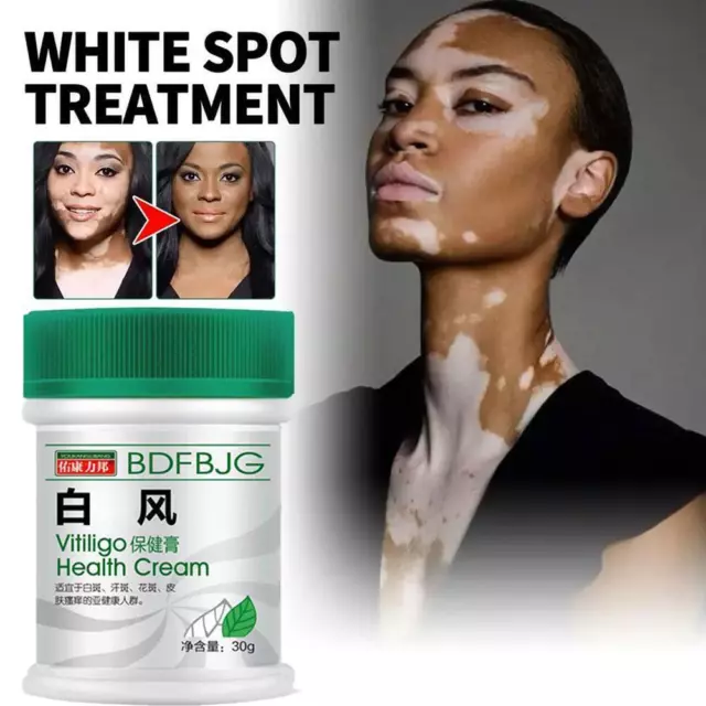 30g Vitiligo Fix Revitalize Elixir Treatment Cream,Treat Soothing Cream V0L2 2