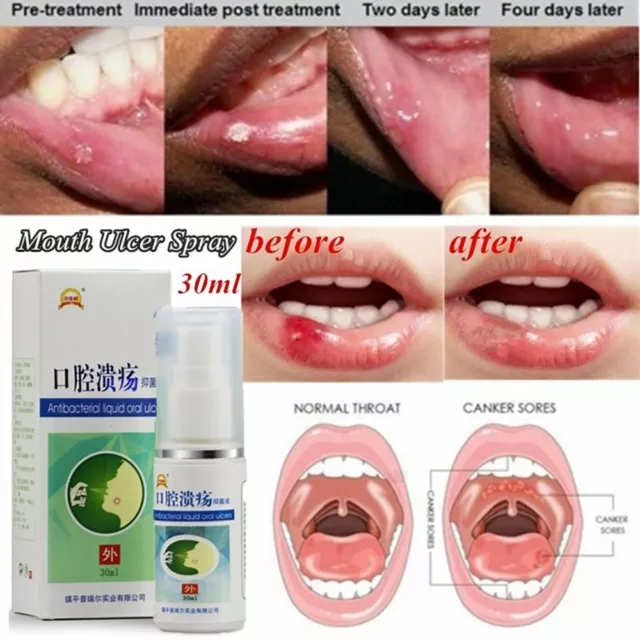 Treatment Herbal Oral Hygiene Health Care Mouth Ulcer Spray Fresh Breath