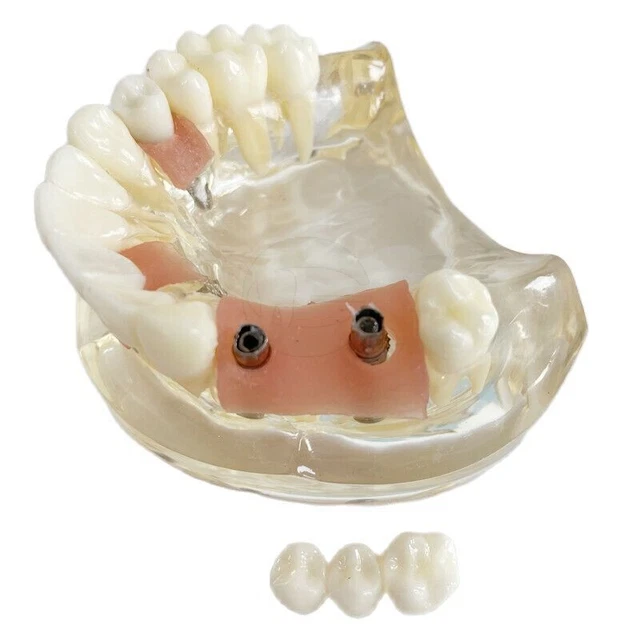DENTAL MODEL FOR Restoration Overdenture/Orthodontic Study/Maryland