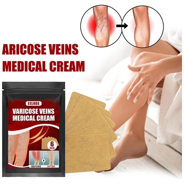 Body Vasculitis Phlebitis Spider Pain Relief Plaster Unisex Health Care Patches 6